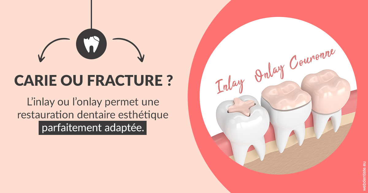 https://dr-zerbib-dan.chirurgiens-dentistes.fr/T2 2023 - Carie ou fracture 2