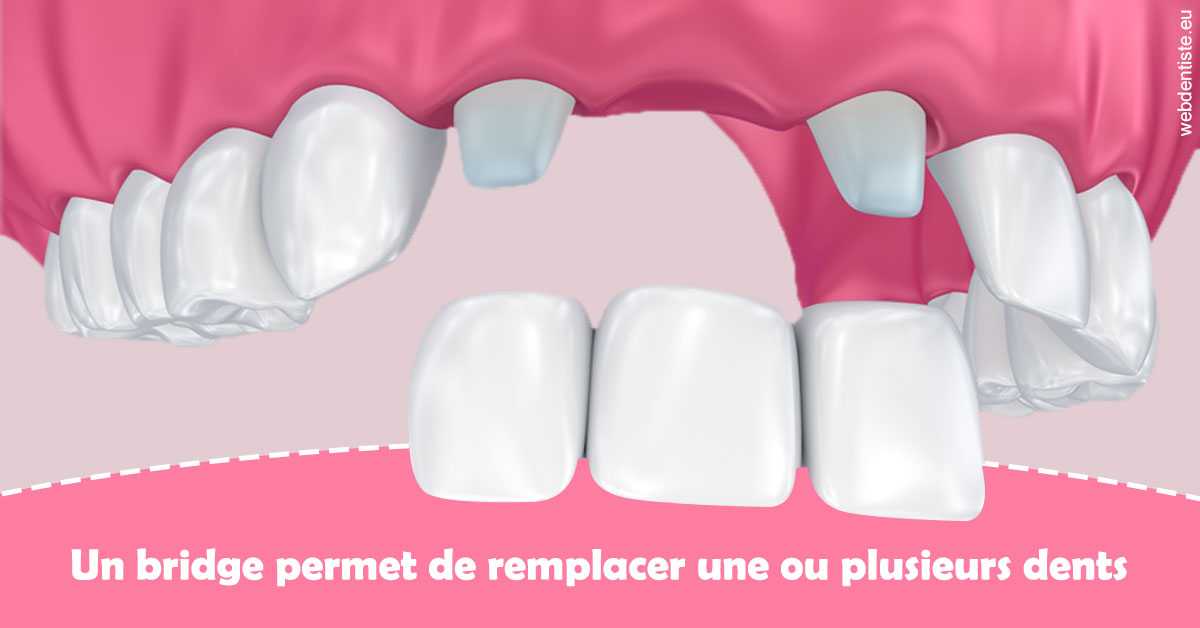 https://dr-zerbib-dan.chirurgiens-dentistes.fr/Bridge remplacer dents 2