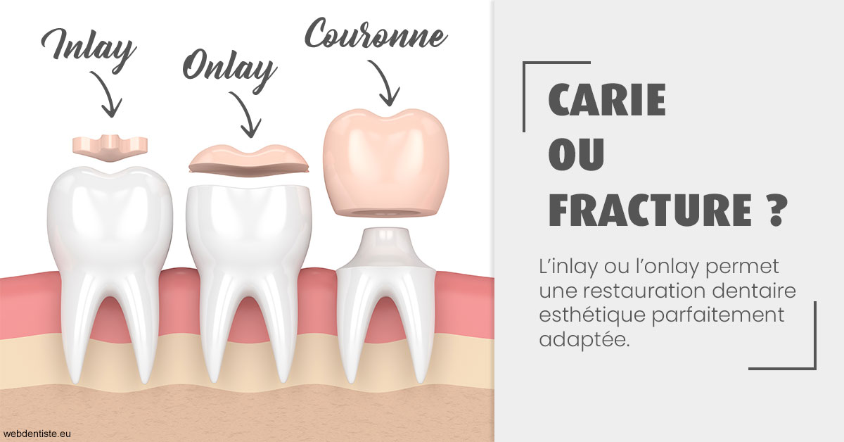 https://dr-zerbib-dan.chirurgiens-dentistes.fr/T2 2023 - Carie ou fracture 1
