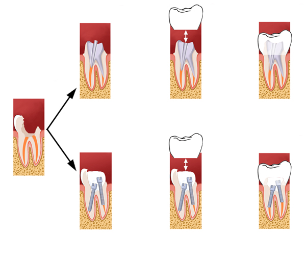 Principales étapes de réalisation d’une couronne dentaire prothétique